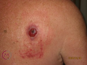 Melanomas