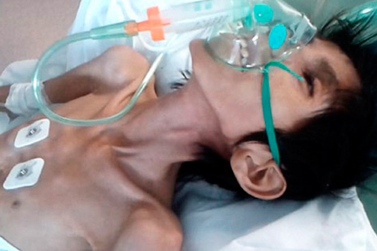 Murió joven qom de 14 años por desnutrición en Chaco