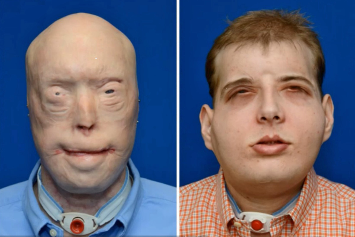 Transplantaron el rostro de un bombero en Estados Unidos