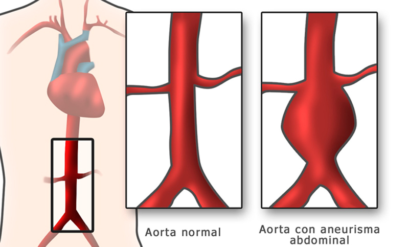 Aneurisma de aorta: patología de importancia por su diagnóstico temprano