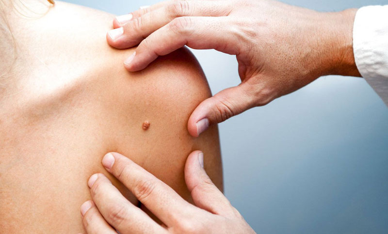 Científicos españoles logran predecir la metástasis de un agresivo cáncer de piel