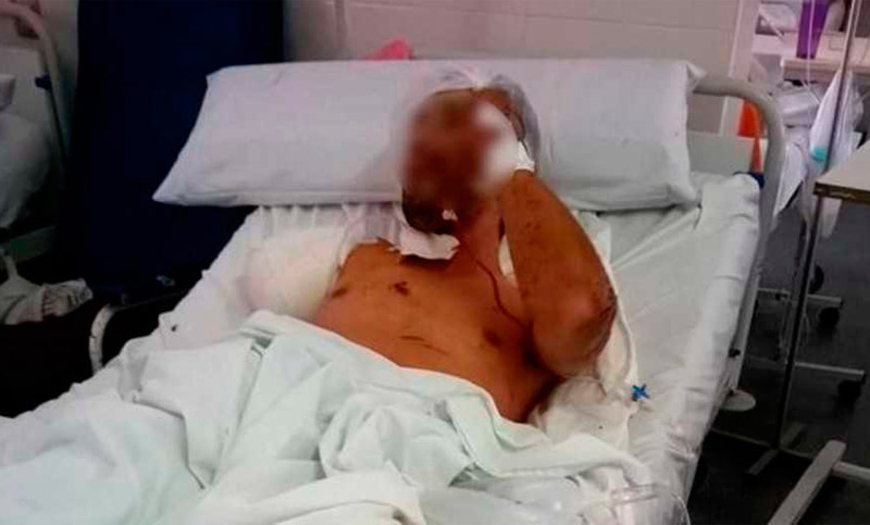 Entró a robar, lo atacó un Pitbull y le amputaron un brazo
