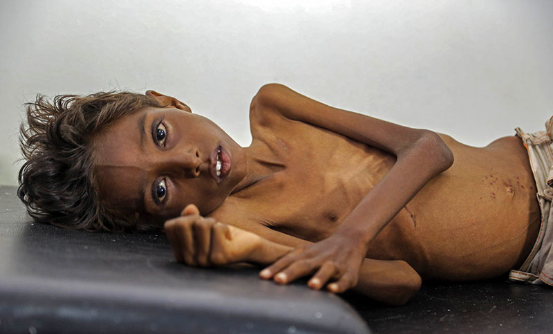 En Yemen, cada diez minutos muere un niño menor de cinco años