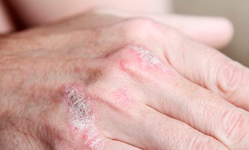 Advierten la importancia de un diagnóstico temprano de la psoriasis, porque puede comprometer otros órganos