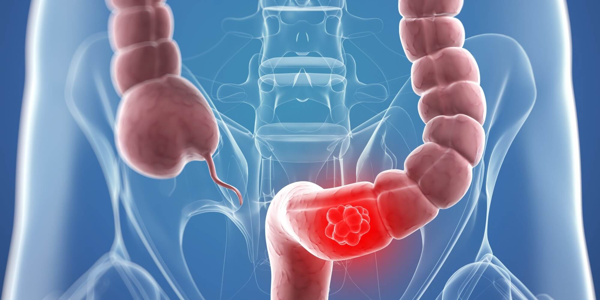 El cáncer de colon brinda muchas oportunidades para realizar acciones preventivas