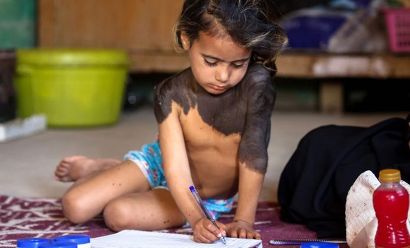 En un pueblo de Irak, una niña vive aislada por culpa de una enfermedad rara