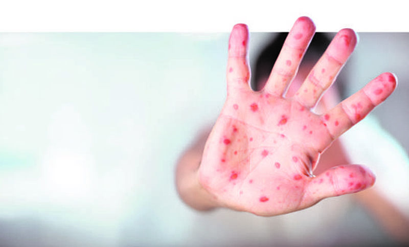 Emitieron un alerta epidemiológico por dos casos autóctonos de sarampión