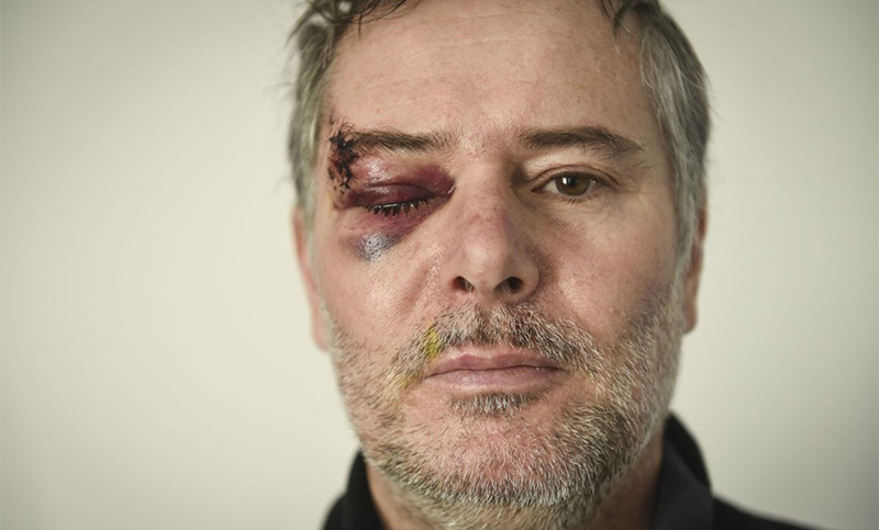 Chalecos amarillos:  un fotógrafo lesionado en el ojo en Rennes