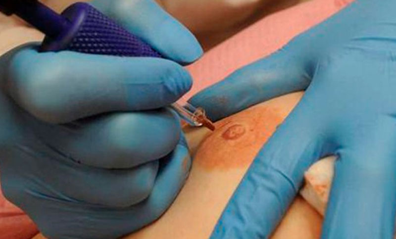 Sanar de todas las formas posibles: reconstrucción de pezón para mujeres que han sufrido una mastectomía
