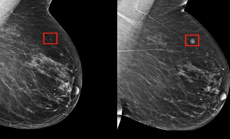 ¿El sistema Google IA podría realmente mejorar la detección temprana del cáncer de mama?