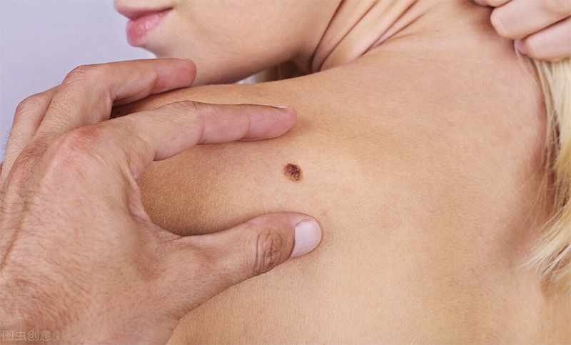 Día Mundial contra el Melanoma: tratamientos, prevenciones y un detalle clave