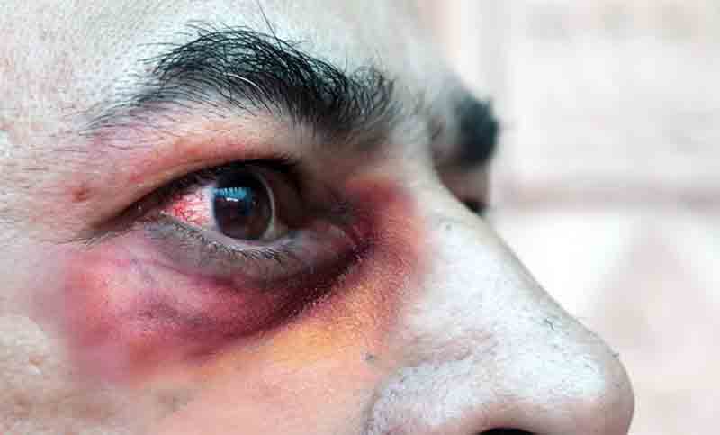 Primera muerte por «hongo negro» en el país: ataca a quienes padecieron coronavirus