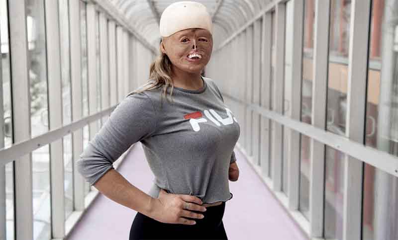 Brisa: a los 7 meses se quemó el 88% de su cuerpo y hoy es deportista y modelo