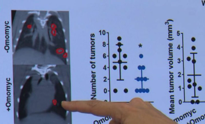 España: un fármaco logró frenar la metástasis en el cáncer de mama 