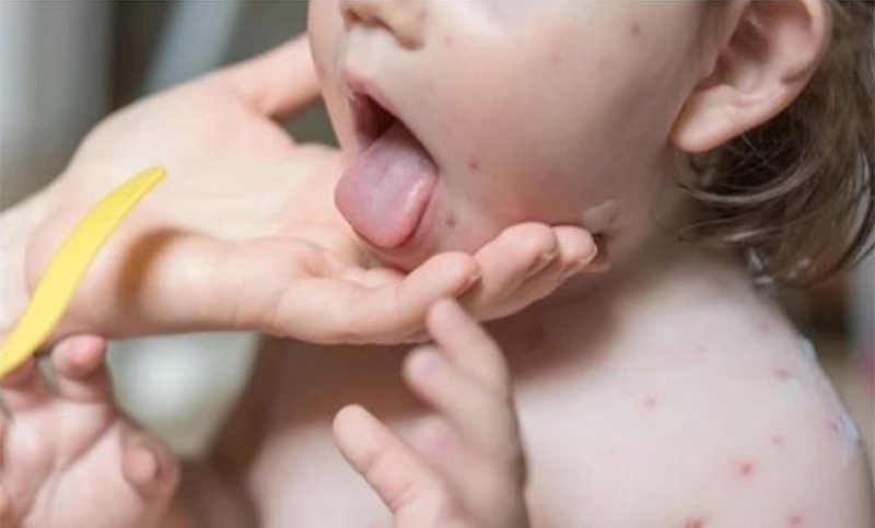 Mano-Pie-Boca y herpangina son algunas de las enfermedades que «volvieron» en pediatría