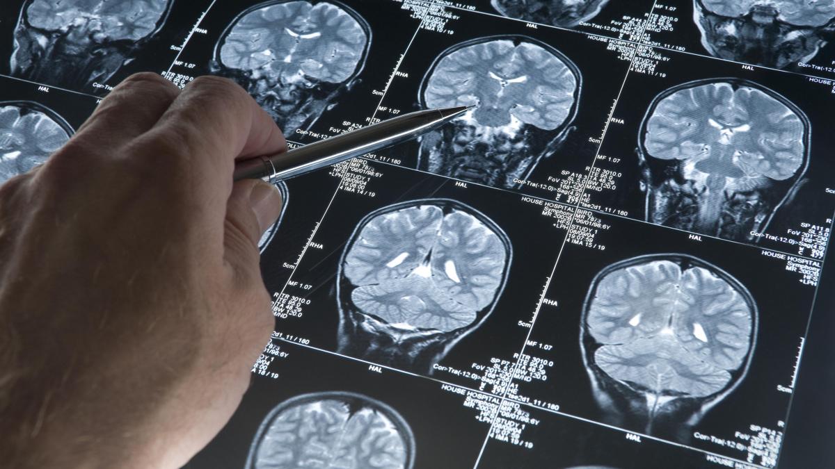 Logran importante avance en investigación para combatir el Alzheimer
