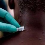 La viruela del mono dejó de ser una emergencia mundial en salud pública