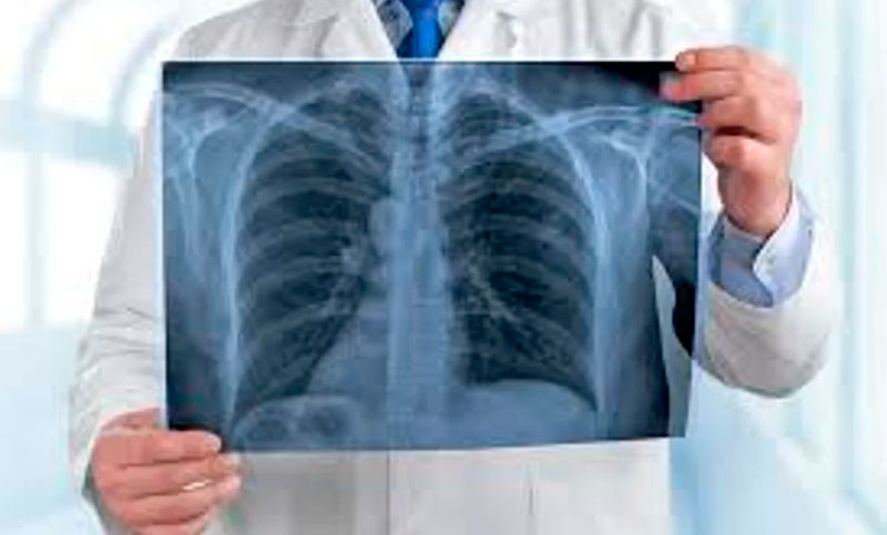 Día Mundial del Cáncer de Pulmón: alertan sobre el aumento de casos