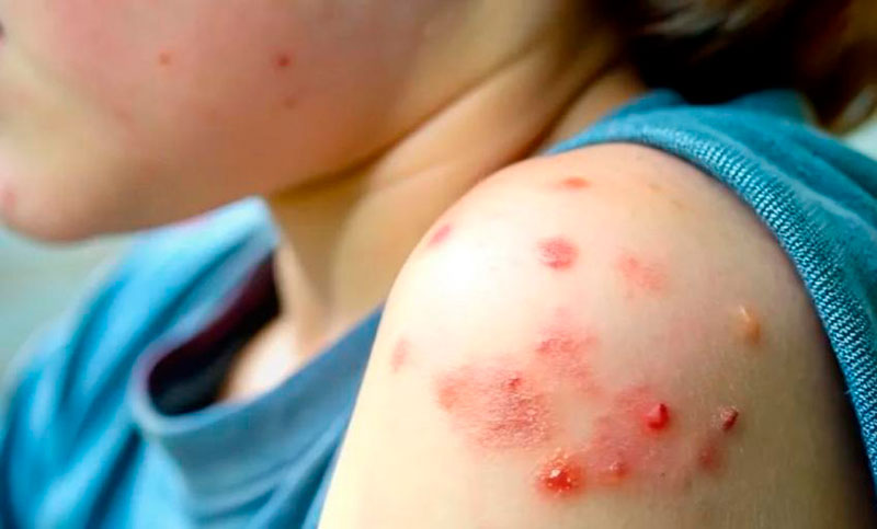 Brote de sarampión en Estados Unidos: más de 250 personas en cuarentena en Carolina del Sur