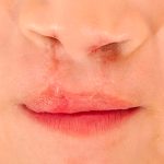 ¿Qué es la Fisura de Labio Alvéolo Palatino?: asociación Sentidos necesita ayuda para finalizar su centro médico especializado de atención gratuita