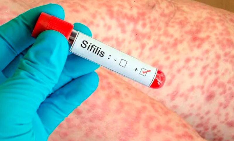 Alerta por el aumento de los casos de sífilis: superan en un 80% el promedio de los últimos cuatro años